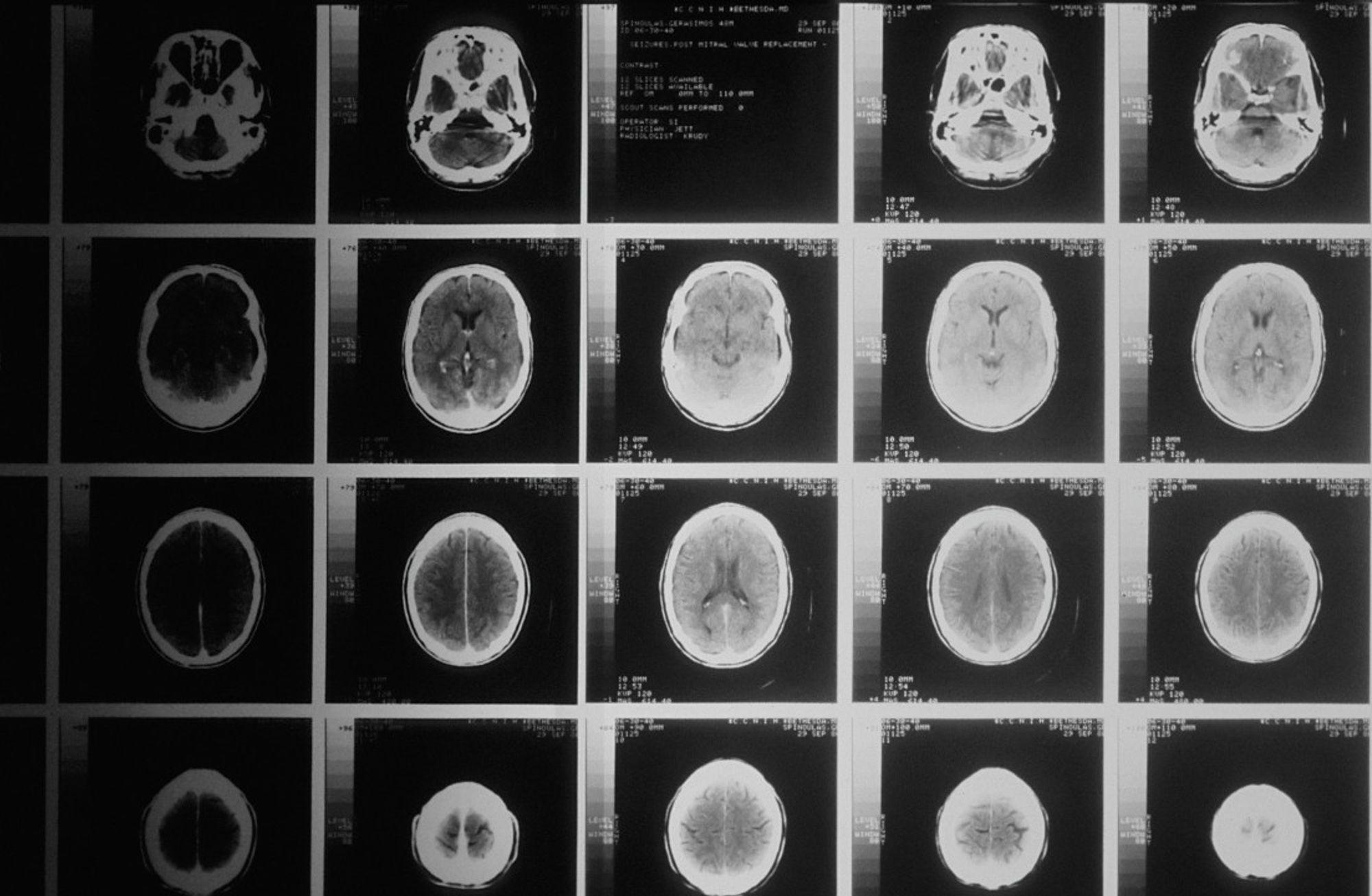 Alzheimer ilerlemesini %35 yavaşlatan yeni bir ilaç geliştirildi