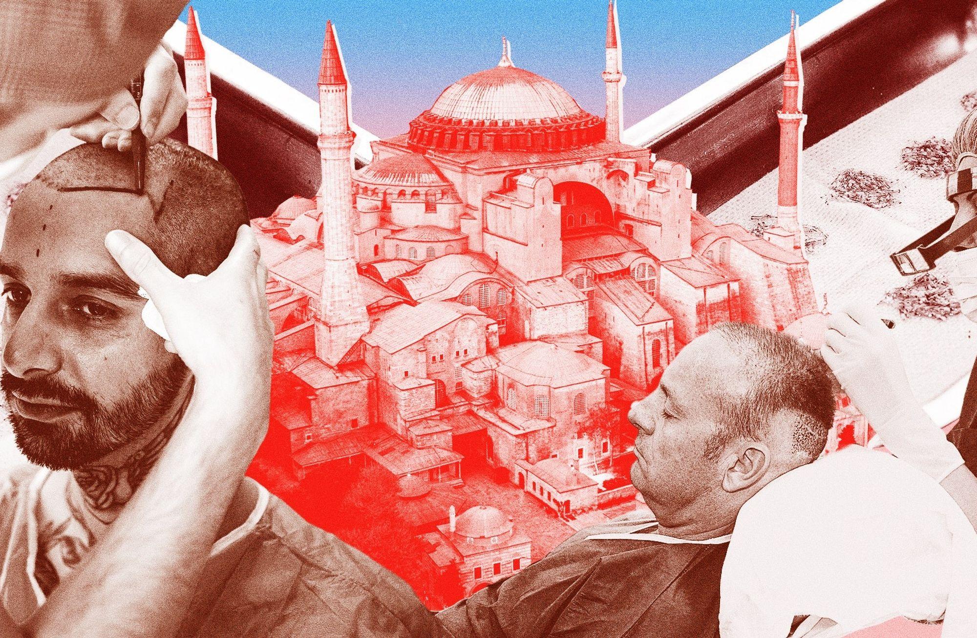 'Turkish Hairlines': Türkiye nasıl saç ekiminin başkenti oldu?